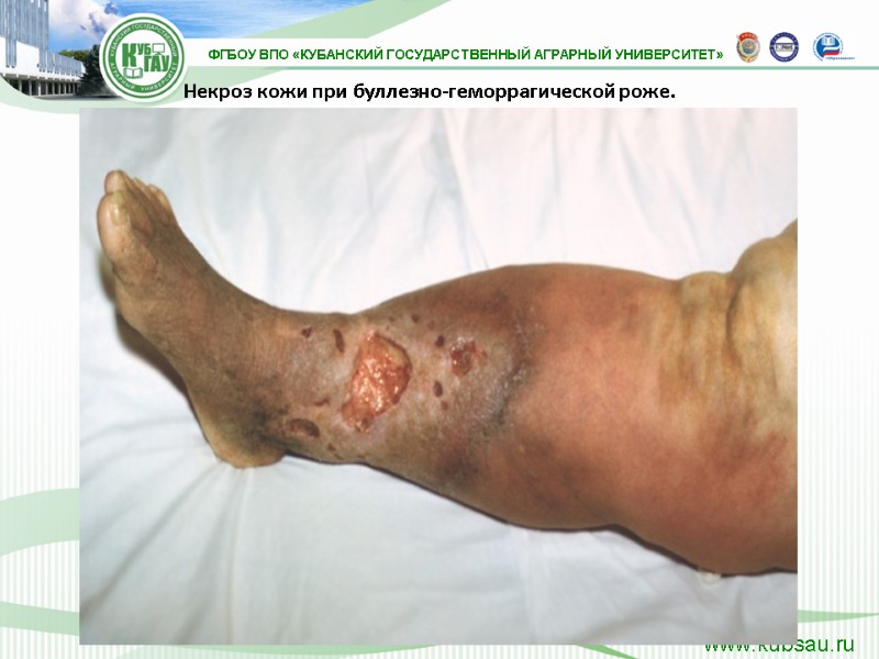 Некроз кожи при буллезно-геморрагической роже.